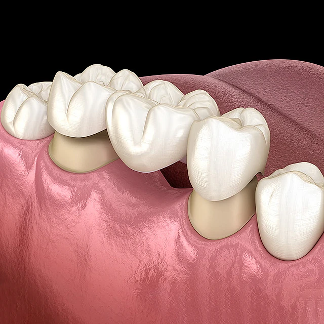 Prótesis dentales