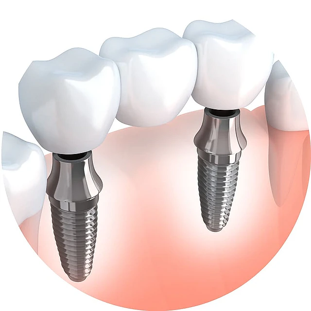 Prótesis dentales fijas